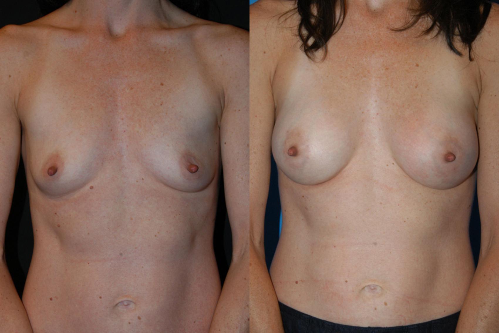 Before & After Breast Augmentation Case 11 View #1 View in Vancouver, BC