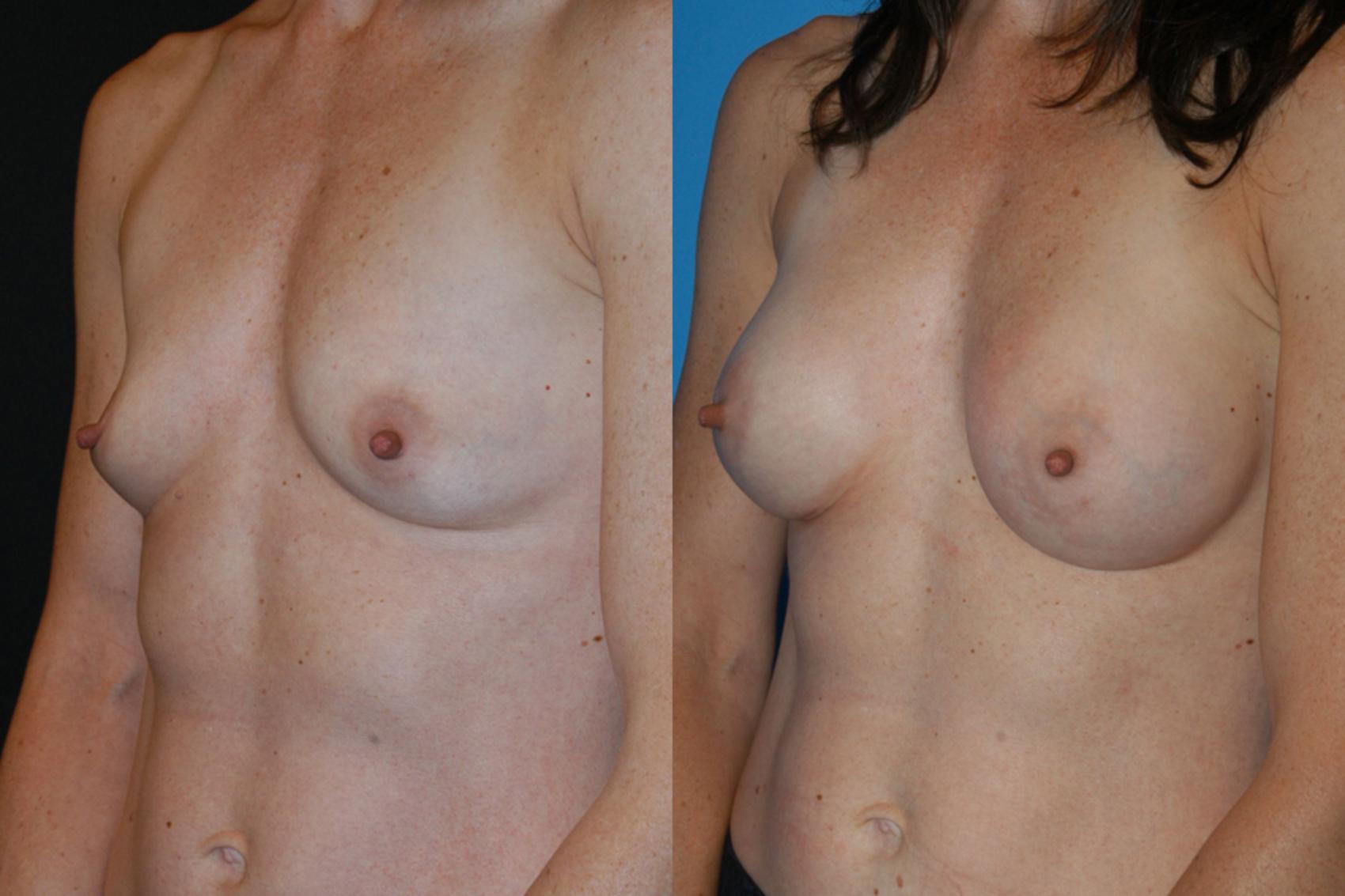 Before & After Breast Augmentation Case 11 View #2 View in Vancouver, BC