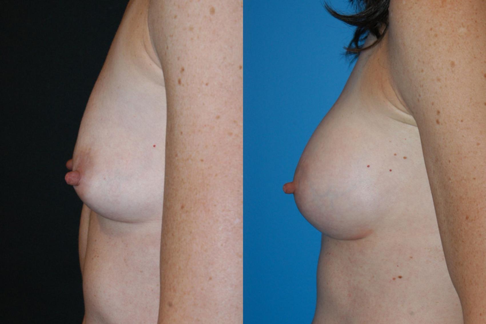 Before & After Breast Augmentation Case 11 View #3 View in Vancouver, BC