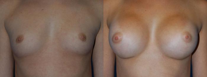 Before & After Breast Augmentation Case 13 View #1 View in Vancouver, BC