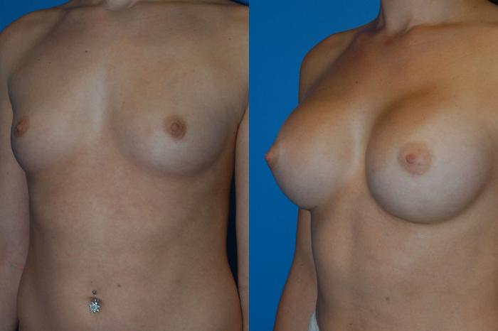 Before & After Breast Augmentation Case 13 View #2 View in Vancouver, BC
