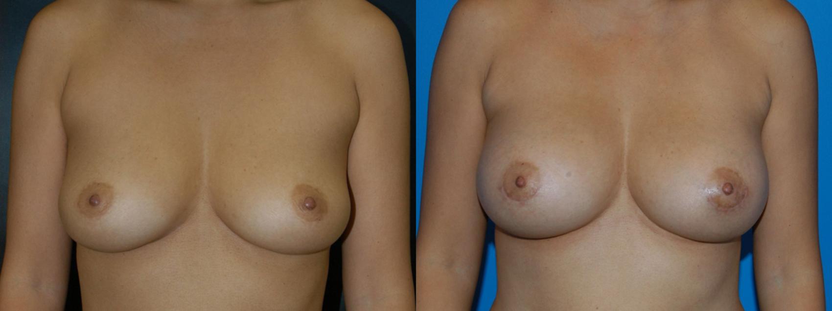 Breast Augmentation Case 17 Before & After View #1 | Vancouver, BC | Dr. Peter Lennox