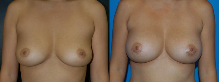 Before & After Breast Augmentation Case 17 View #1 View in Vancouver, BC