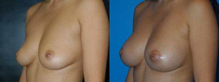 Before & After Breast Augmentation Case 17 View #2 View in Vancouver, BC