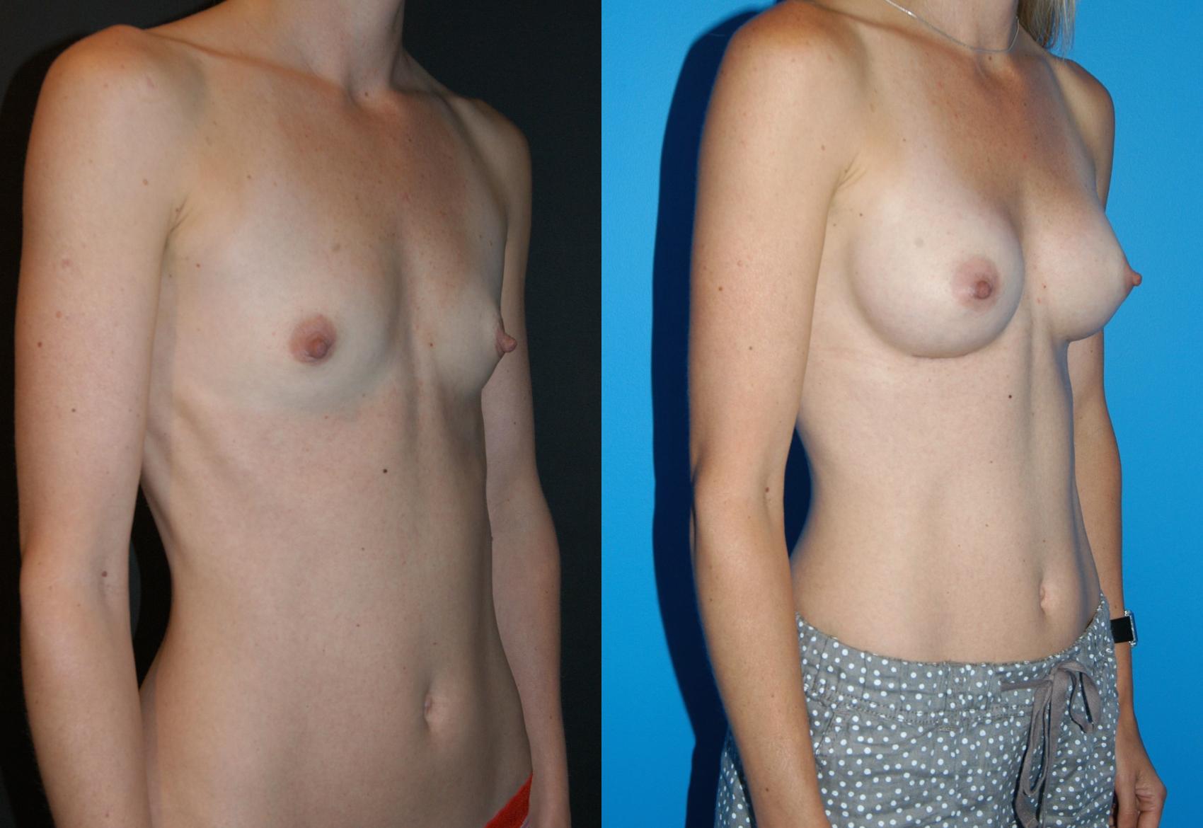 Breast Augmentation Case 18 Before & After View #1 | Vancouver, BC | Dr. Peter Lennox