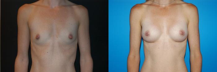 Before & After Breast Augmentation Case 18 View #2 View in Vancouver, BC