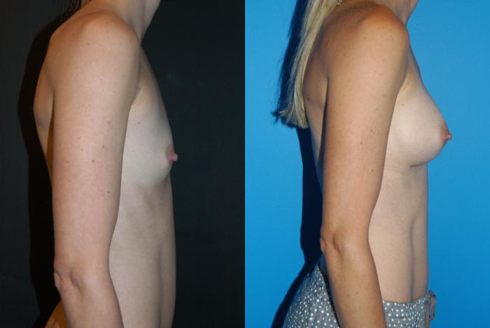 Before & After Breast Augmentation Case 18 View #3 View in Vancouver, BC