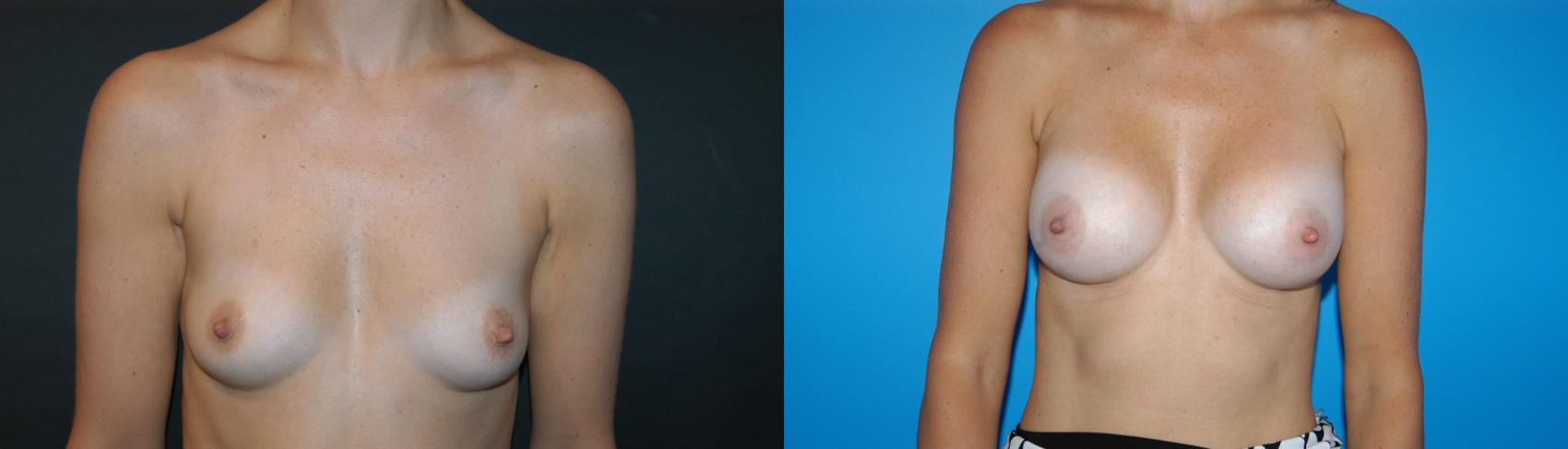 Before & After Breast Augmentation Case 19 View #1 View in Vancouver, BC