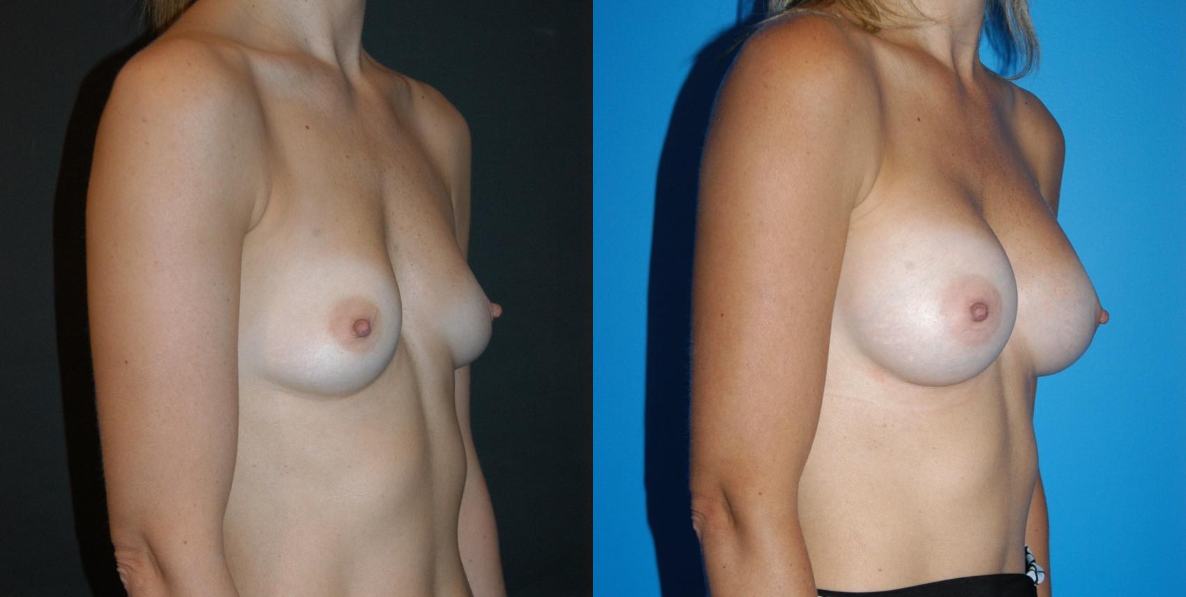 Before & After Breast Augmentation Case 19 View #2 View in Vancouver, BC