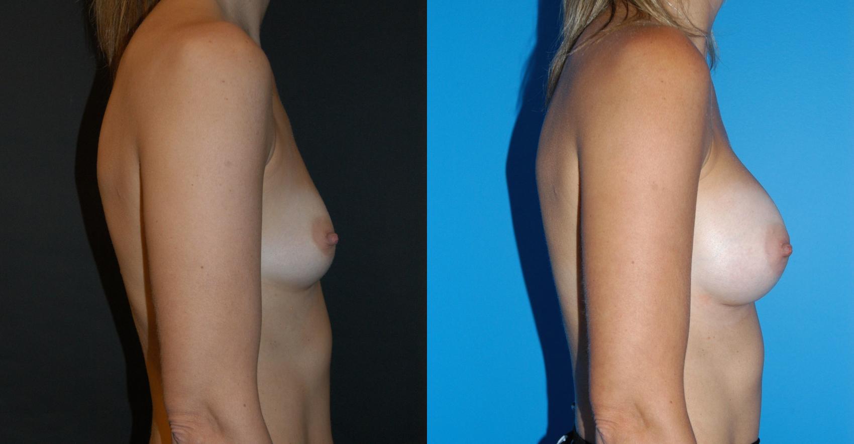 Before & After Breast Augmentation Case 19 View #3 View in Vancouver, BC