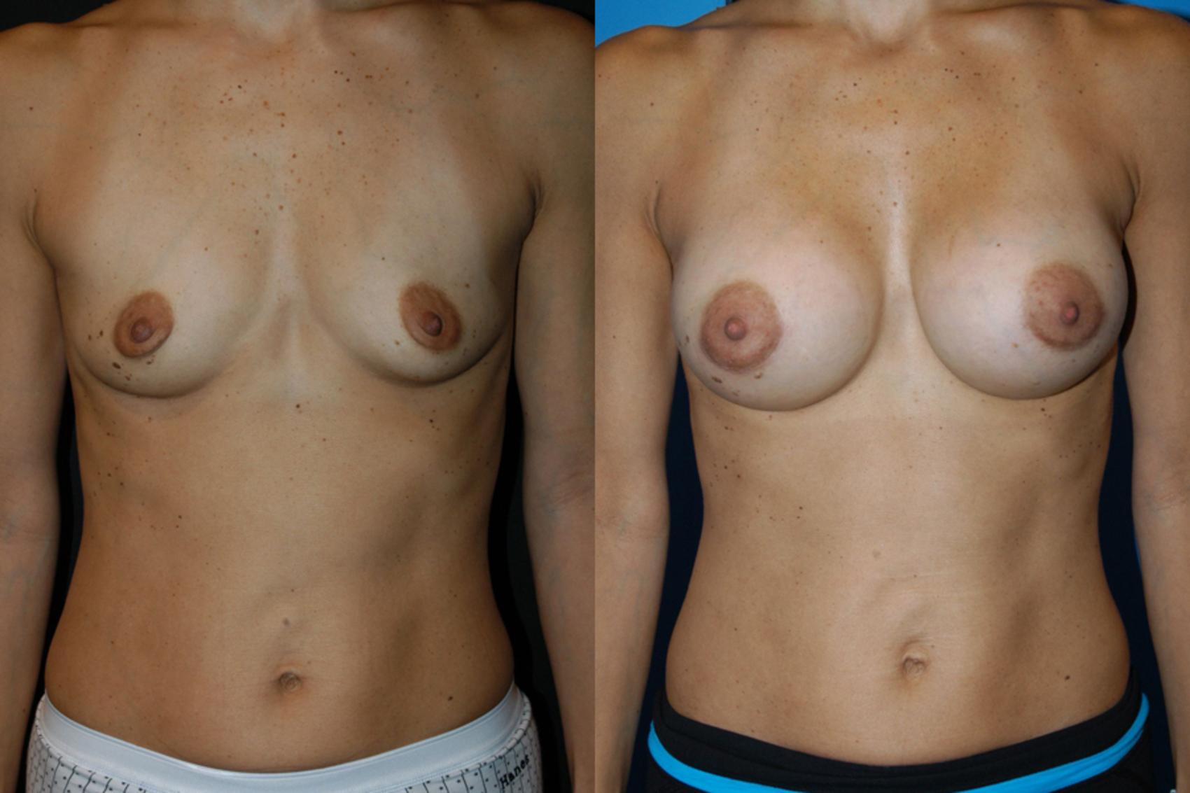 Breast Augmentation Case 2 Before & After View #2 | Vancouver, BC | Dr. Peter Lennox