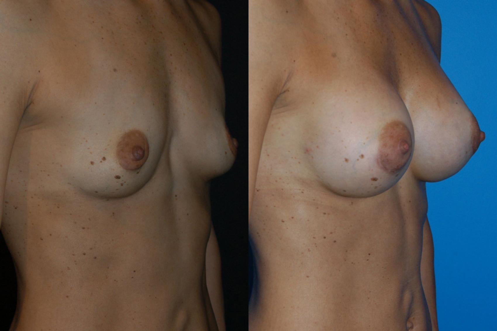 Breast Augmentation Case 2 Before & After View #3 | Vancouver, BC | Dr. Peter Lennox