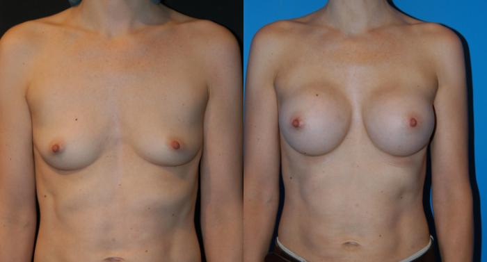 Before & After Breast Augmentation Case 20 View #1 View in Vancouver, BC