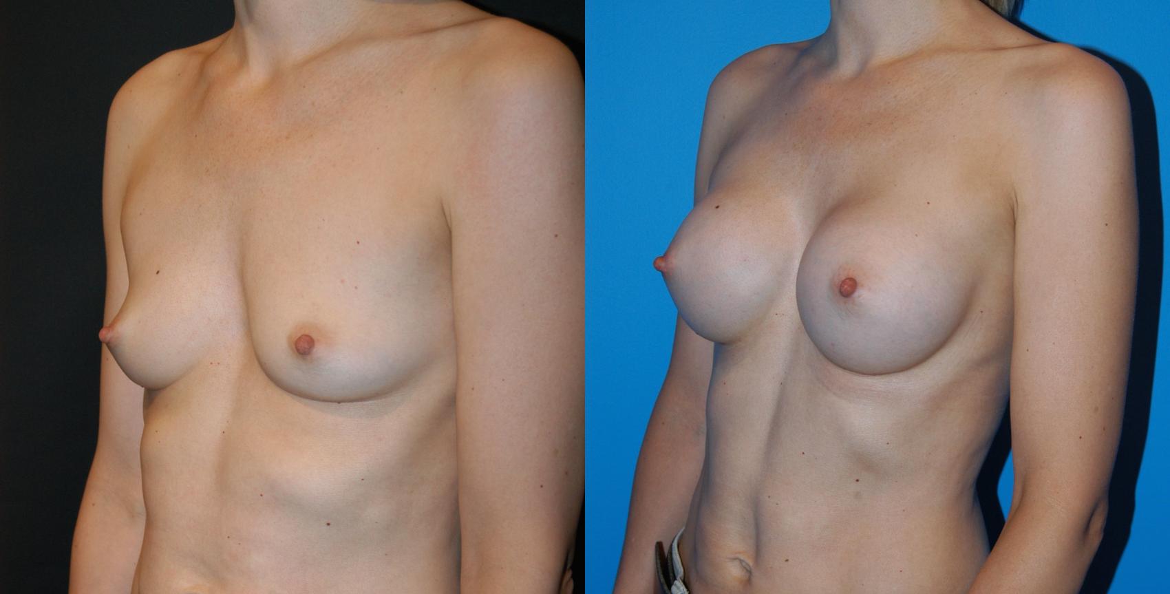 Before & After Breast Augmentation Case 20 View #2 View in Vancouver, BC