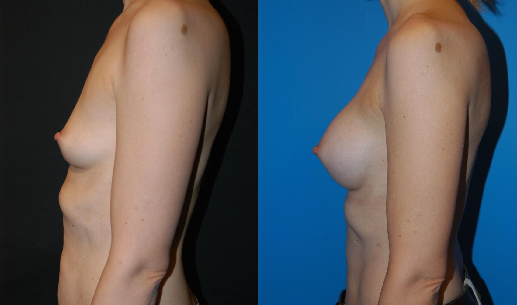 Before & After Breast Augmentation Case 20 View #3 View in Vancouver, BC