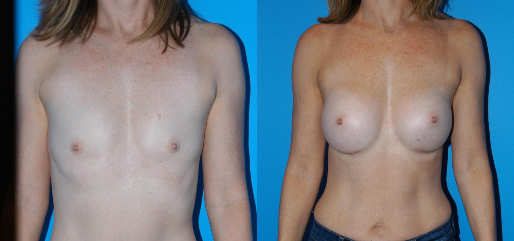 Breast Augmentation Case 22 Before & After View #1 | Vancouver, BC | Dr. Peter Lennox