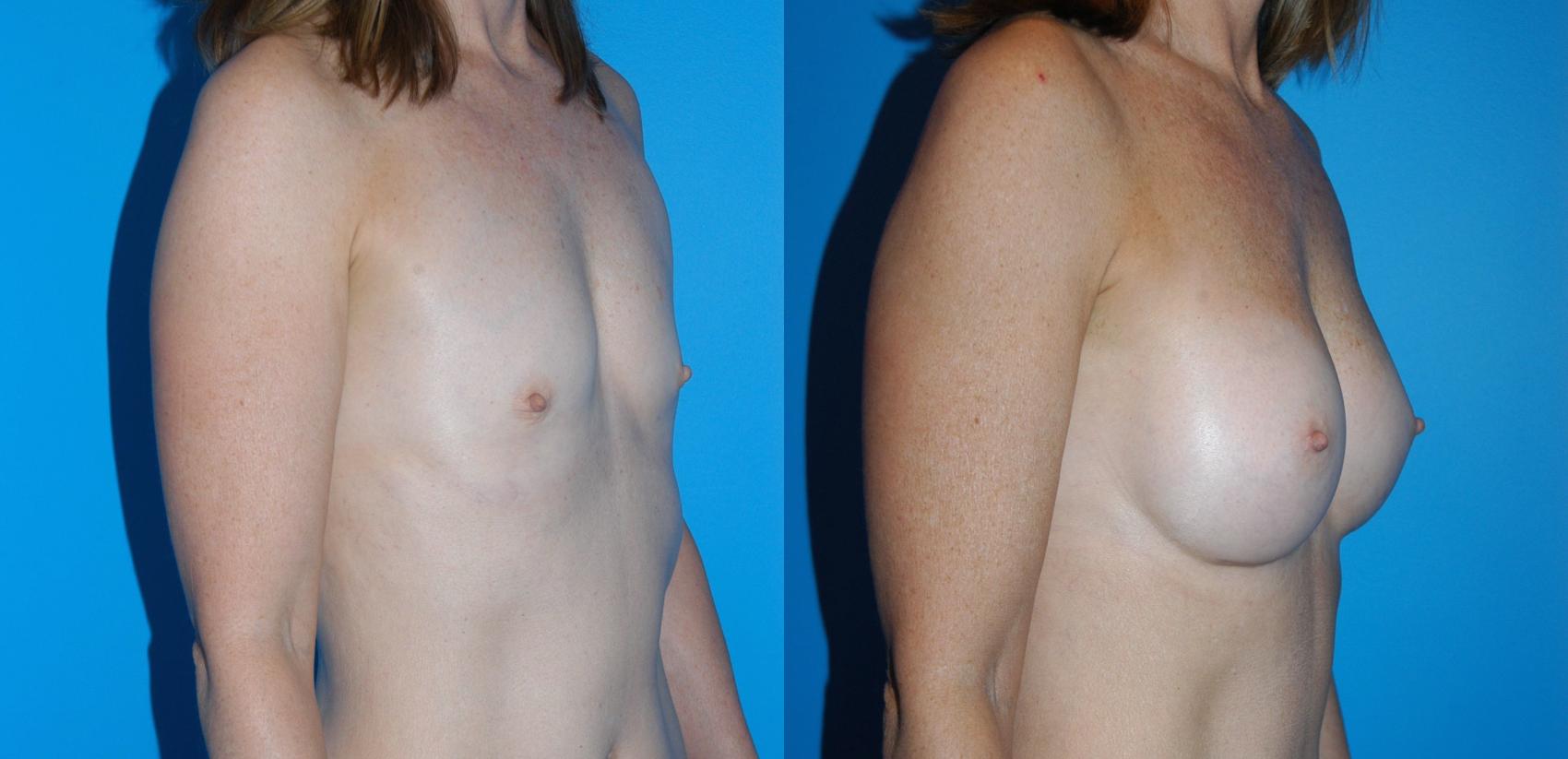 Breast Augmentation Case 22 Before & After View #2 | Vancouver, BC | Dr. Peter Lennox