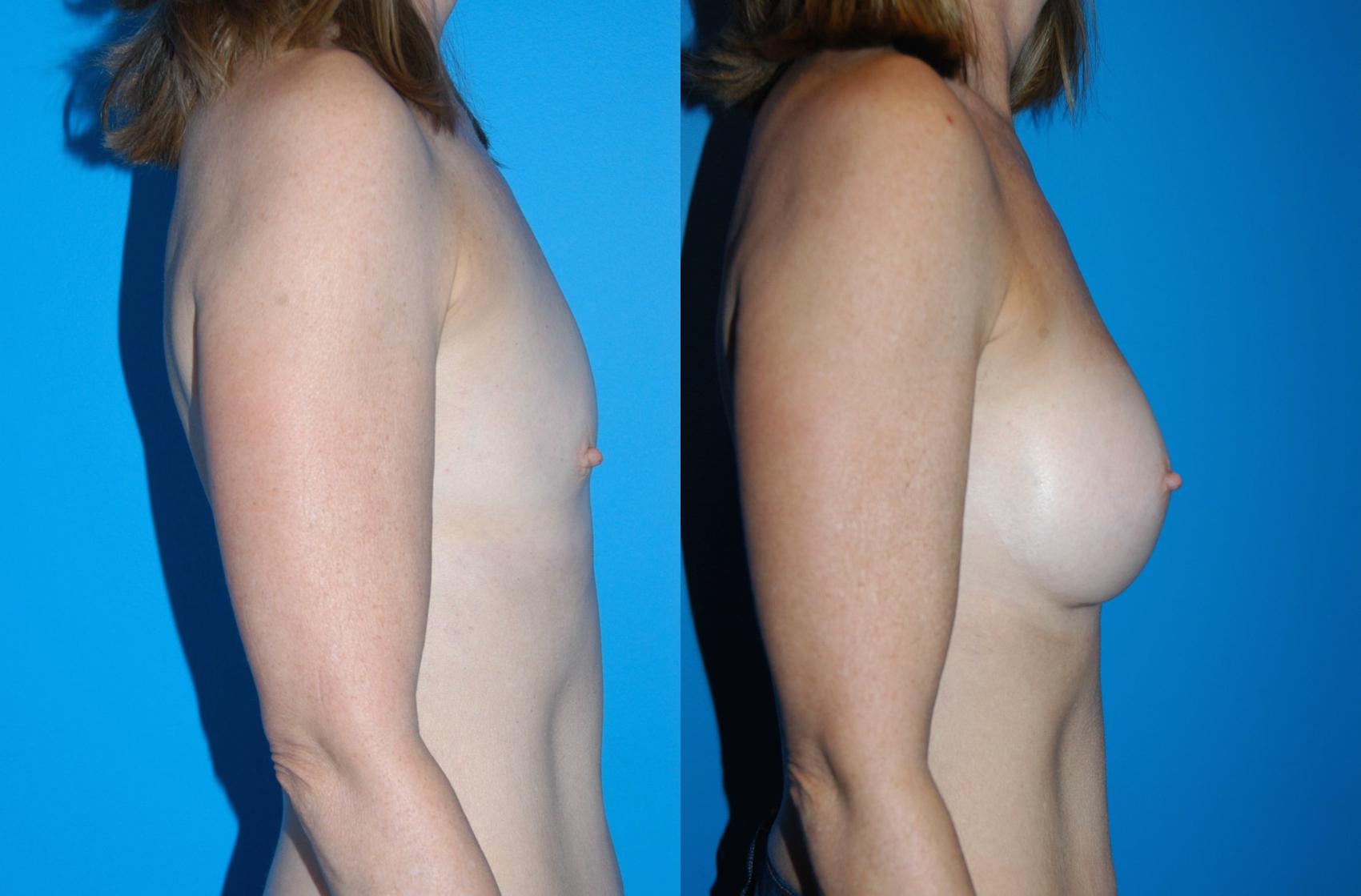 Breast Augmentation Case 22 Before & After View #3 | Vancouver, BC | Dr. Peter Lennox