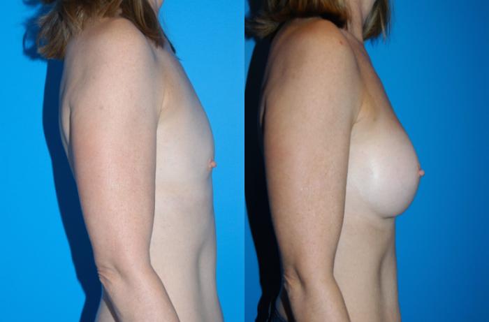 Before & After Breast Augmentation Case 22 View #3 View in Vancouver, BC