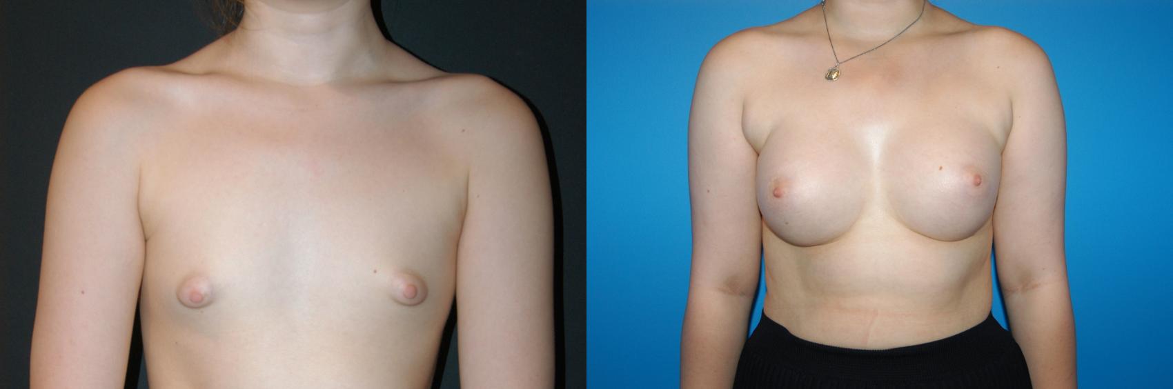 Breast Augmentation Case 24 Before & After View #1 | Vancouver, BC | Dr. Peter Lennox