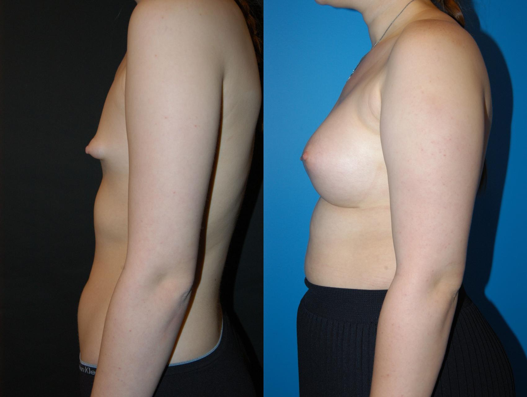 Breast Augmentation Case 24 Before & After View #2 | Vancouver, BC | Dr. Peter Lennox