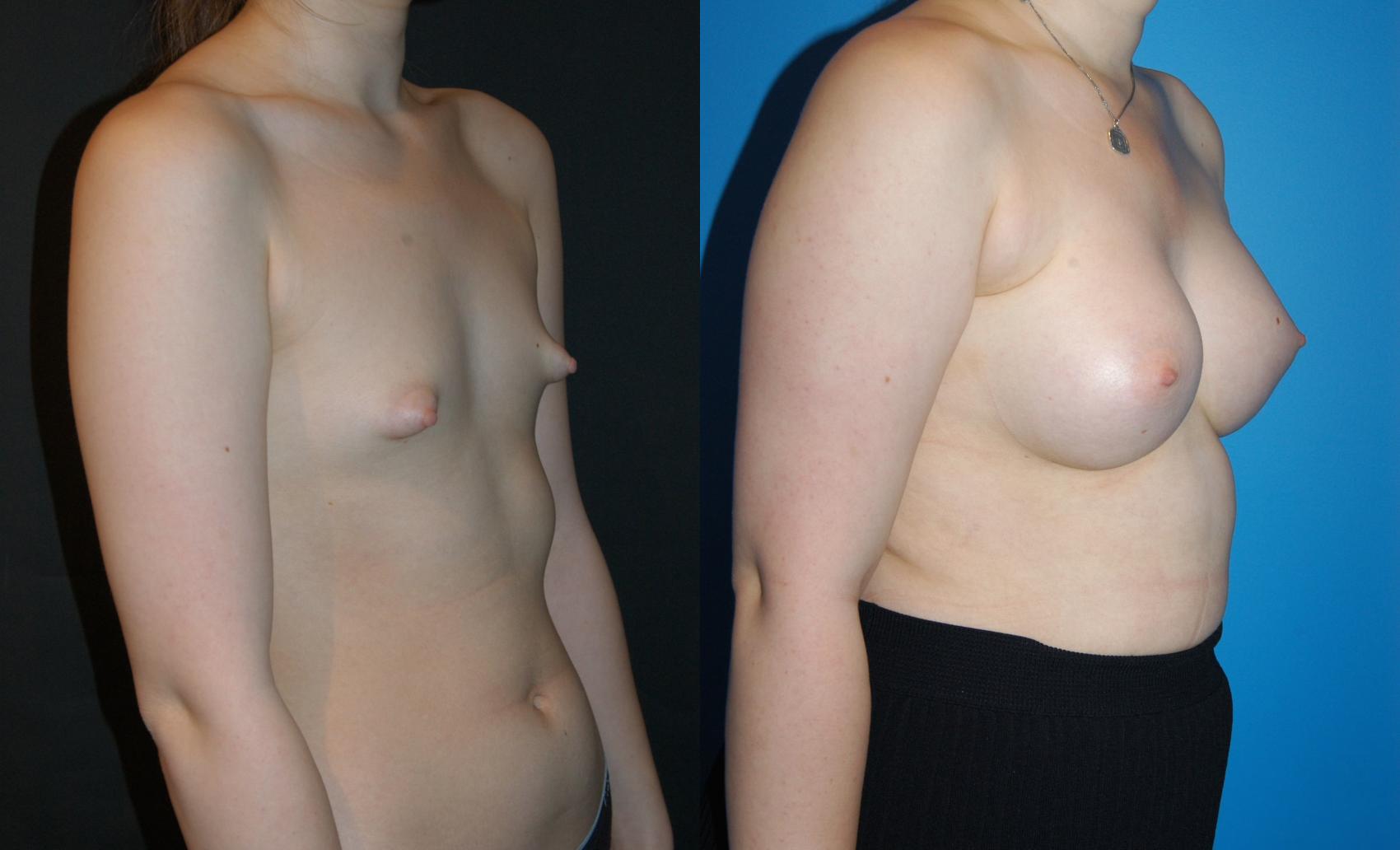 Before & After Breast Augmentation Case 24 View #3 View in Vancouver, BC