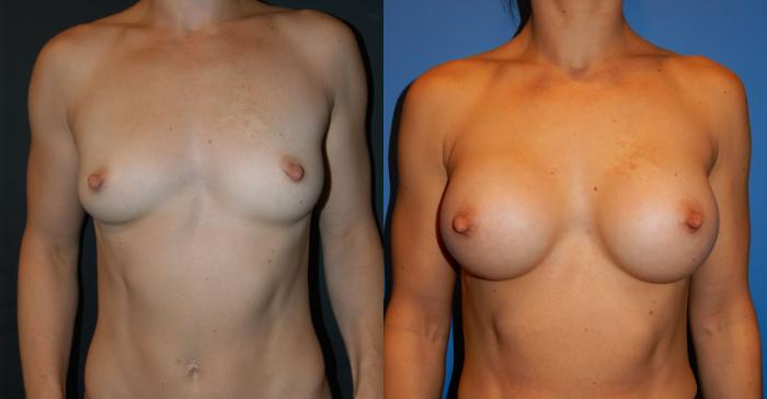Before & After Breast Augmentation Case 28 View #1 View in Vancouver, BC