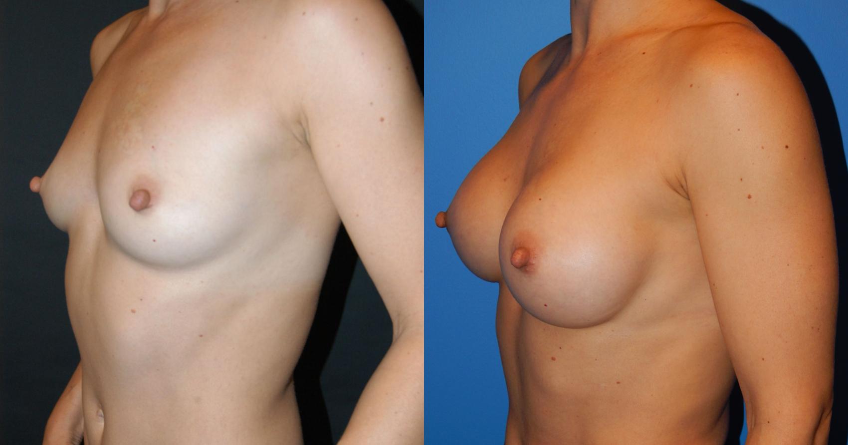 Before & After Breast Augmentation Case 28 View #2 View in Vancouver, BC