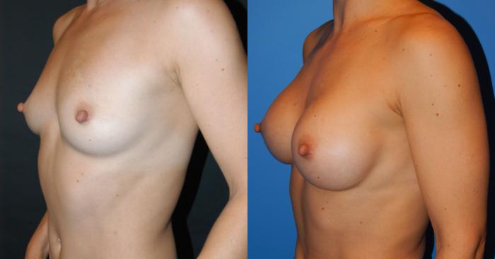Before & After Breast Augmentation Case 28 View #2 View in Vancouver, BC