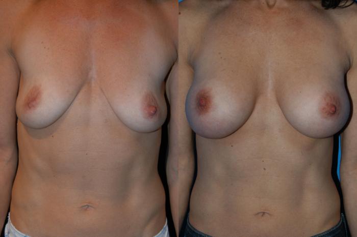 Before & After Breast Augmentation Case 3 View #1 View in Vancouver, BC