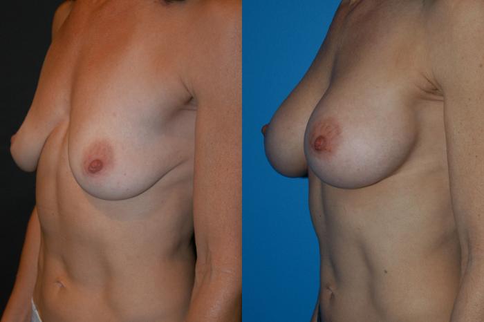 Before & After Breast Augmentation Case 3 View #2 View in Vancouver, BC
