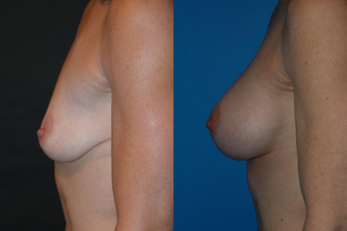 Before & After Breast Augmentation Case 3 View #3 View in Vancouver, BC