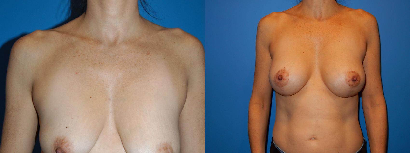 Breast Augmentation Case 32 Before & After View #1 | Vancouver, BC | Dr. Peter Lennox