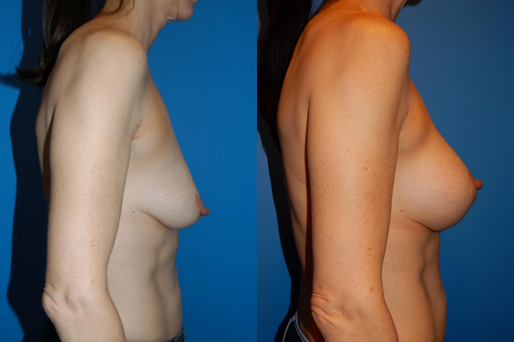 Before & After Breast Augmentation Case 32 View #2 View in Vancouver, BC