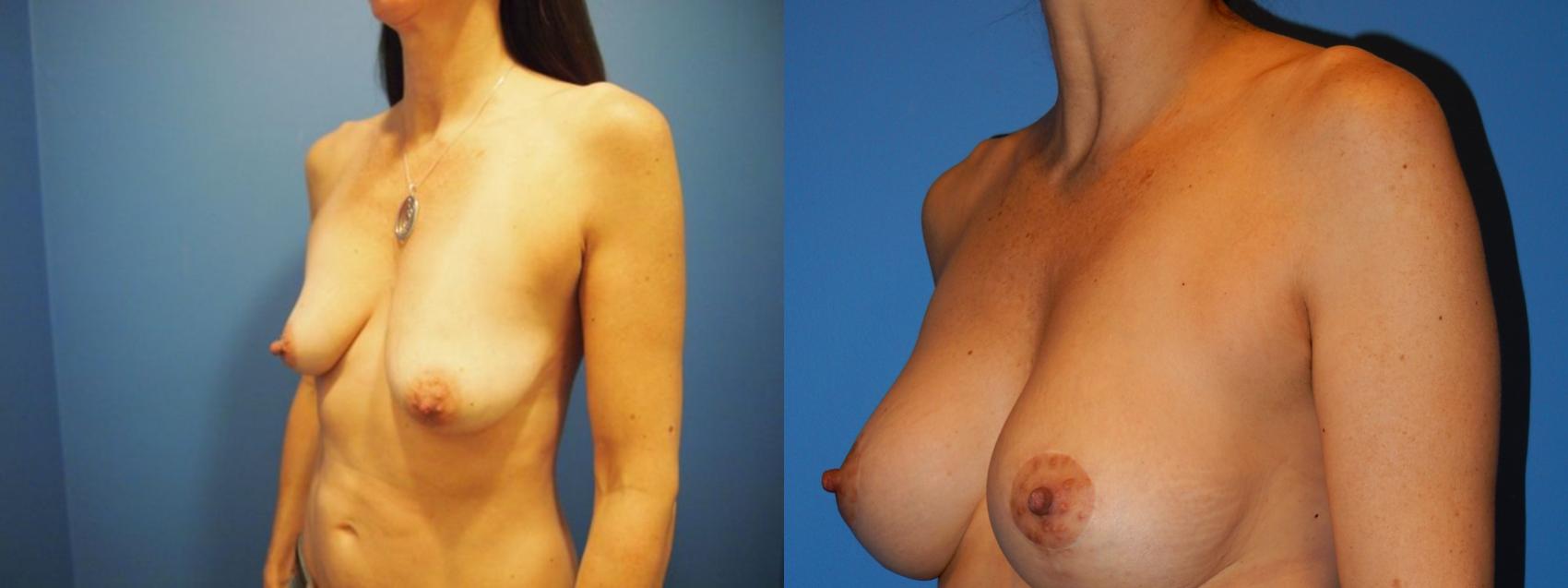 Breast Augmentation Case 32 Before & After View #3 | Vancouver, BC | Dr. Peter Lennox