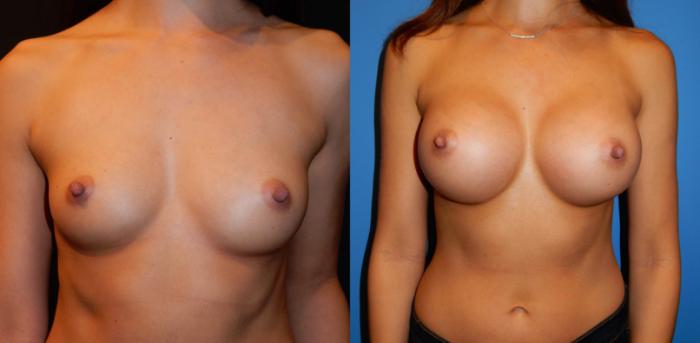 Before & After Breast Augmentation Case 34 View #1 View in Vancouver, BC