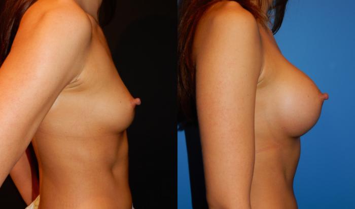 Before & After Breast Augmentation Case 34 View #3 View in Vancouver, BC