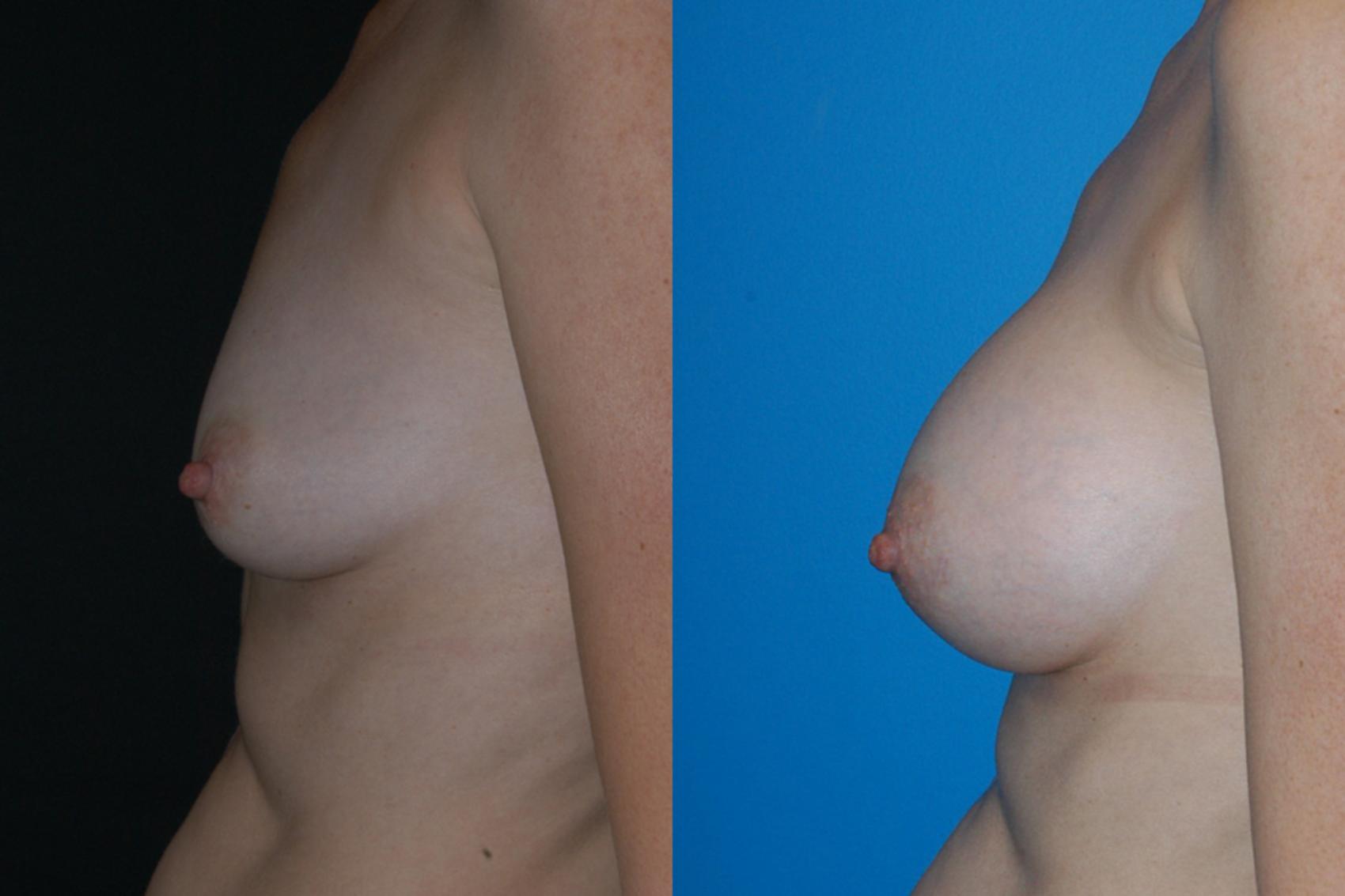 Breast Augmentation Case 4 Before & After View #2 | Vancouver, BC | Dr. Peter Lennox