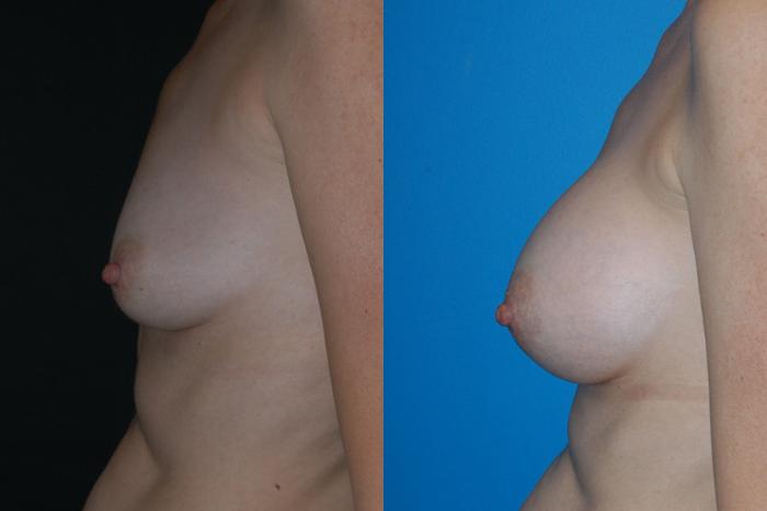 Before & After Breast Augmentation Case 4 View #2 View in Vancouver, BC