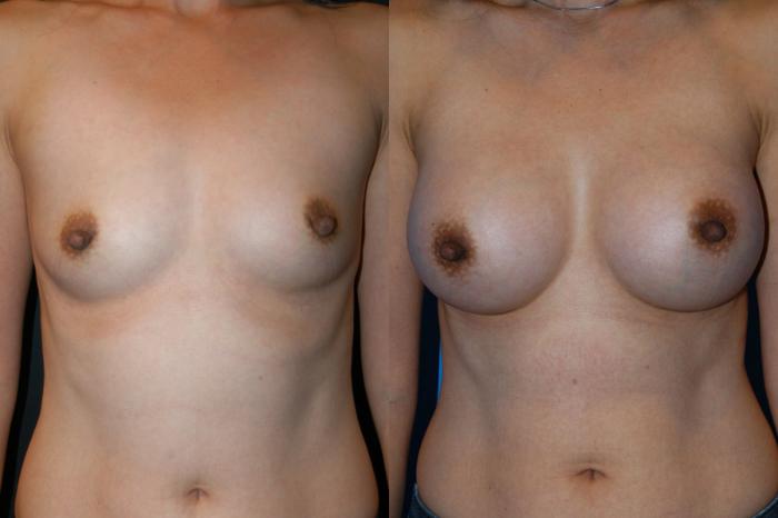 Before & After Breast Augmentation Case 6 View #1 View in Vancouver, BC