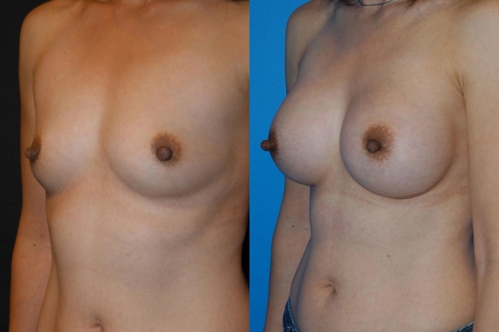 Before & After Breast Augmentation Case 6 View #2 View in Vancouver, BC