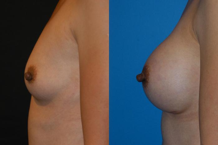 Before & After Breast Augmentation Case 6 View #3 View in Vancouver, BC