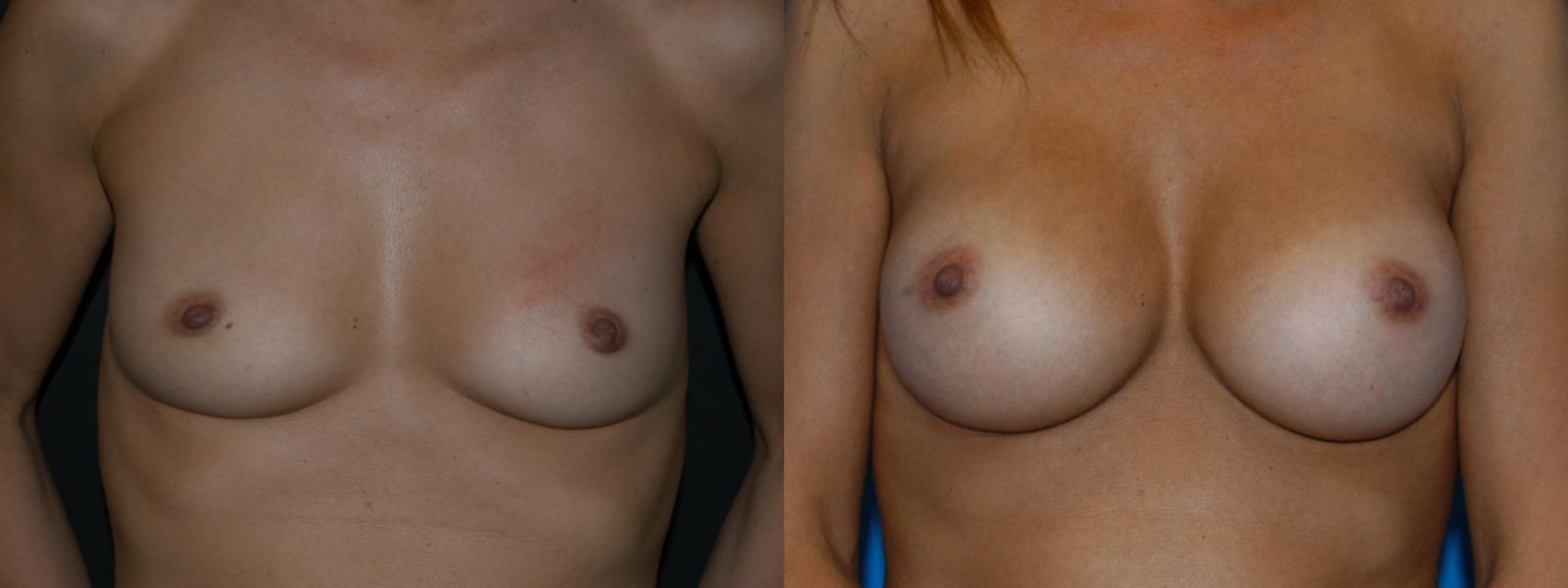 Breast Augmentation Case 9 Before & After View #1 | Vancouver, BC | Dr. Peter Lennox