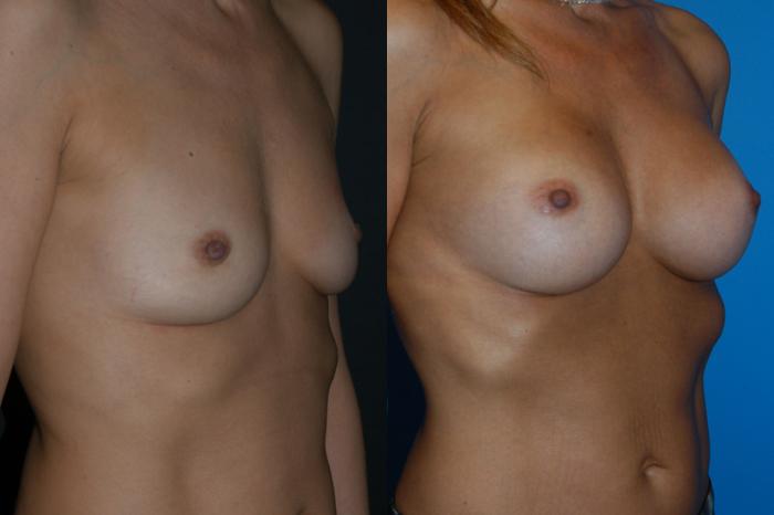 Before & After Breast Augmentation Case 9 View #2 View in Vancouver, BC