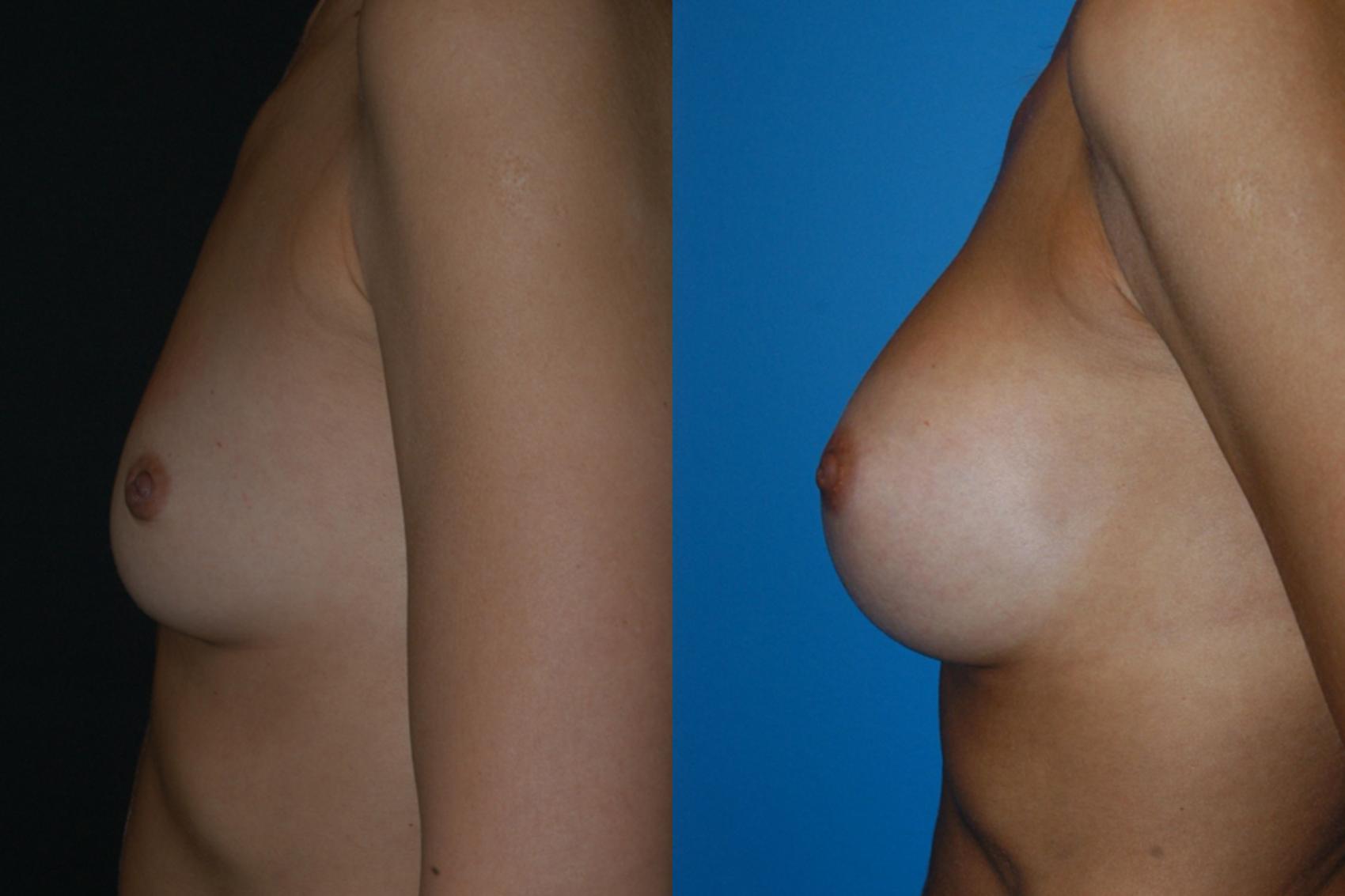 Before & After Breast Augmentation Case 9 View #3 View in Vancouver, BC