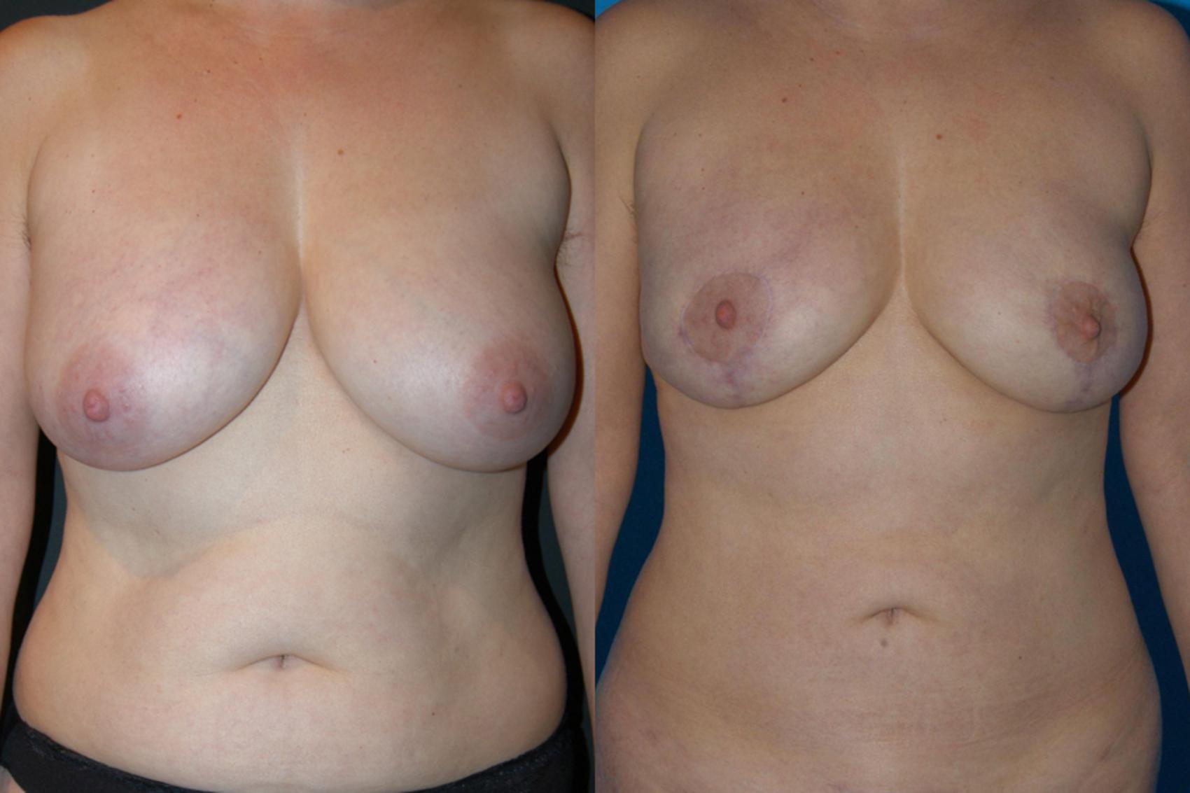 Before & After Breast Lift Case 14 View #1 View in Vancouver, BC