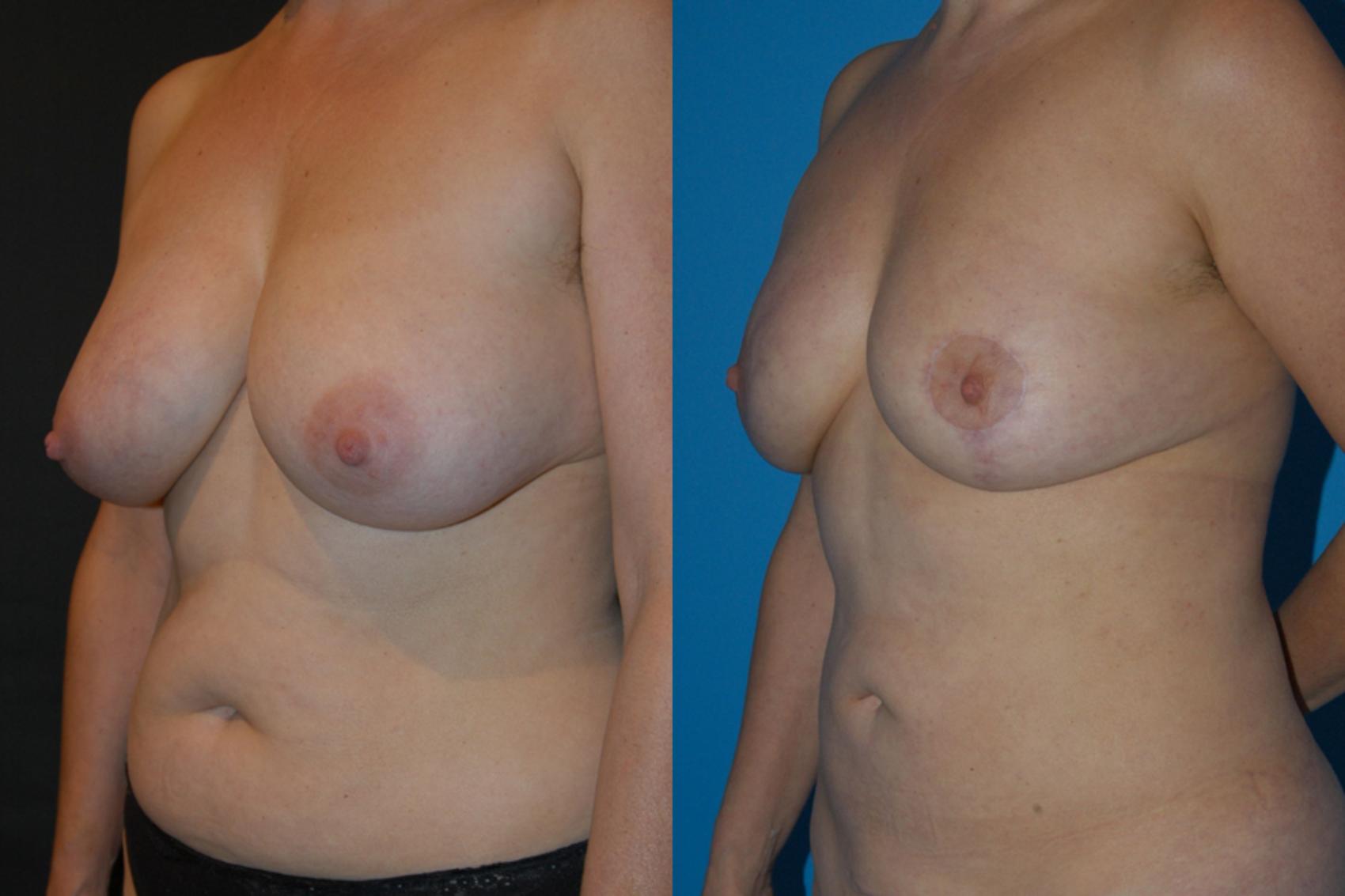 Before & After Breast Lift Case 14 View #2 View in Vancouver, BC