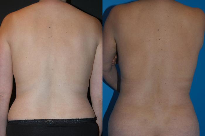 Before & After Breast Lift Case 14 View #3 View in Vancouver, BC