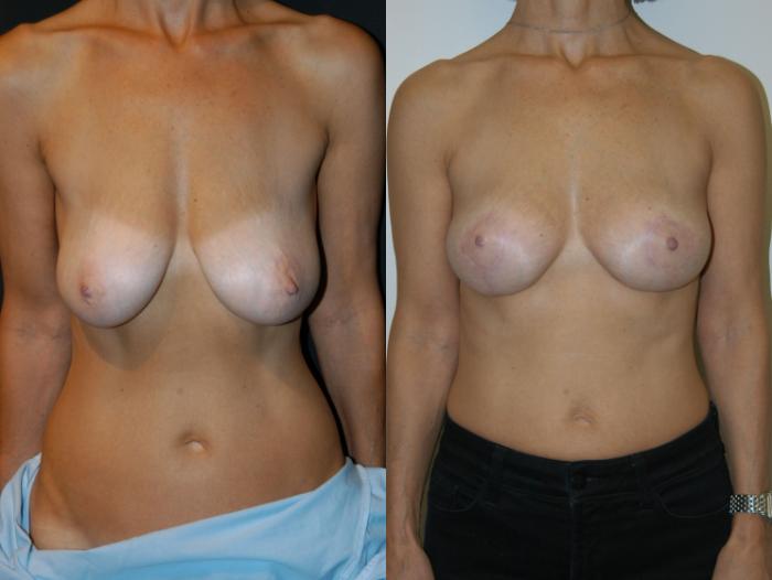 Before & After Breast Lift Case 26 View #1 View in Vancouver, BC