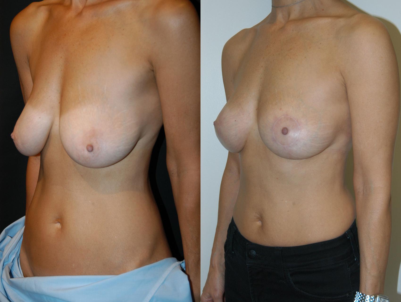 Breast Lift Case 26 Before & After View #2 | Vancouver, BC | Dr. Peter Lennox